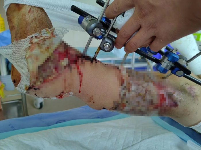 術(shù)后 術(shù)后